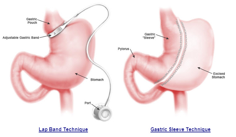Gastric Sleeve vs Gastric Band