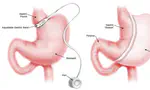 Gastric Sleeve vs Gastric Band