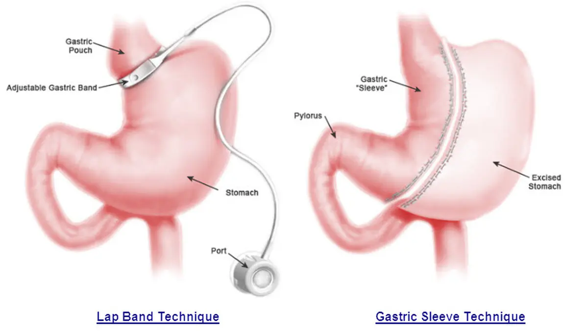 Gastric Sleeve vs Gastric Band